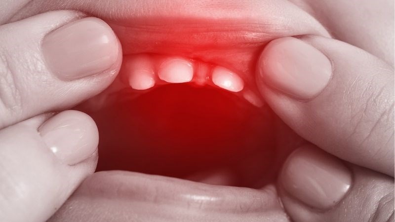 Nướu sưng là một dấu hiệu chắc chắn rằng bé đang mọc răng