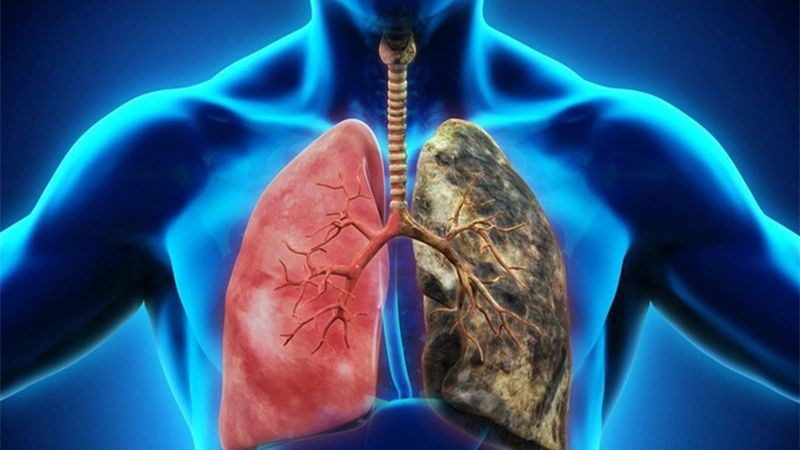 Các chất gây ô nhiễm xung quanh và trong nhà có thể là nguyên nhân ung thư phổi