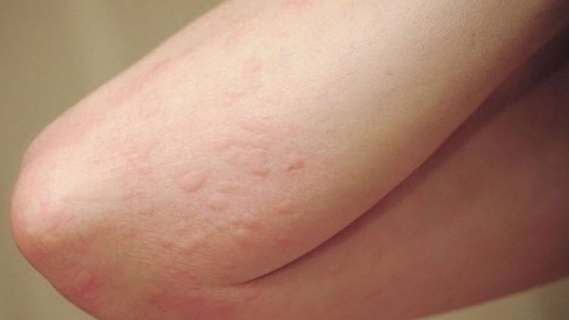 Người làm việc ngoài trời phải đối mặt với các phản ứng dị ứng