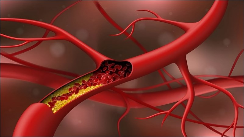 Tinh dầu sả chanh giảm được lượng cholesterol xấu cho cơ thể