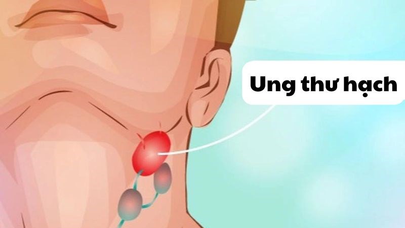Ung thư hạch là một thể bệnh của ung thư máu