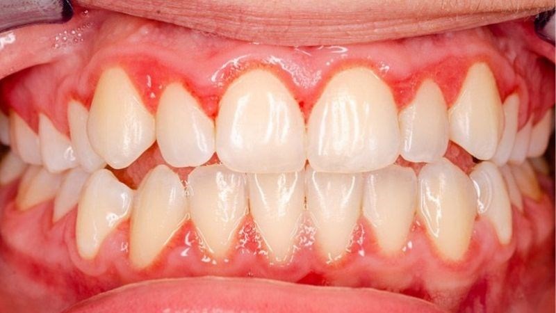 15 bệnh lý răng miệng thường gặp, nguyên nhân và cách điều trị