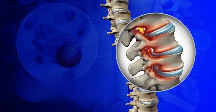 Thoái hóa cột sống ngực có thể gây hẹp ống sống Thoái hóa cột sống ngực có thể gây hẹp ống sống