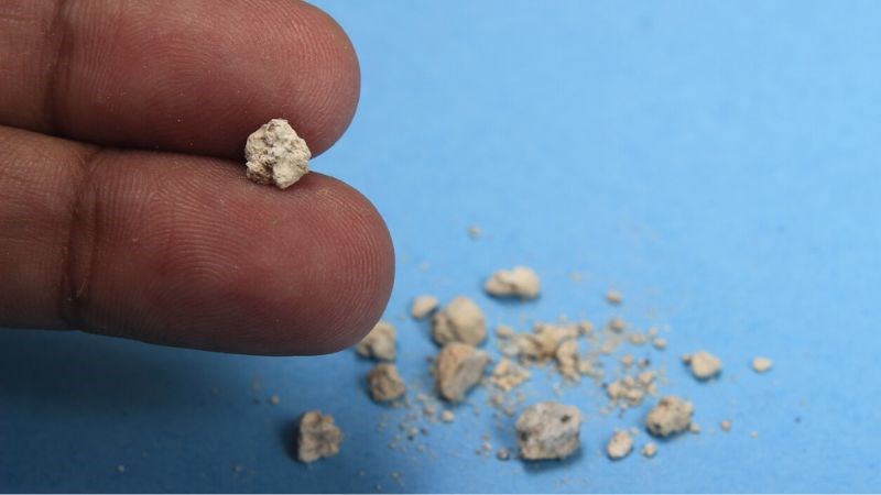 Sỏi canxi oxalat là loại sỏi thận phổ biến nhất