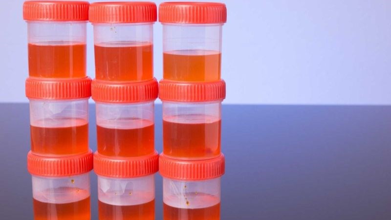 Nước tiểu đỏ là dấu hiệu cần phải đến gặp bác sĩ sớm
