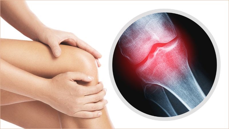 Collagen thủy phân được chứng minh là có tác dụng cải thiện tình trạng viêm xương khớp