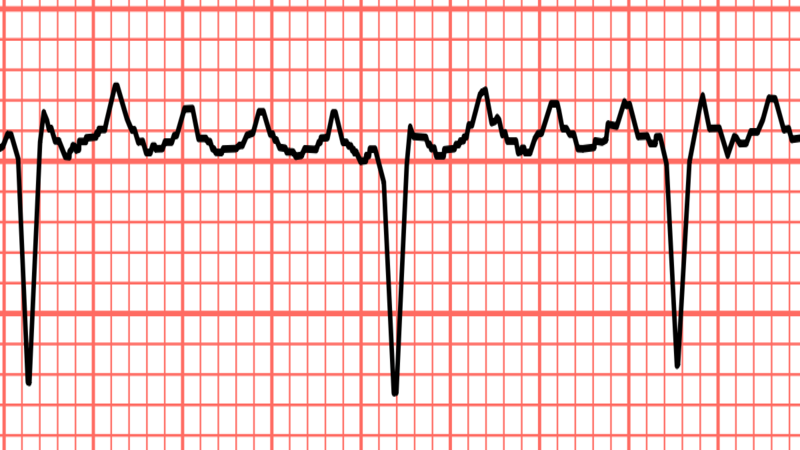 Trong cuồng nhĩ ECG có dạng răng cưa