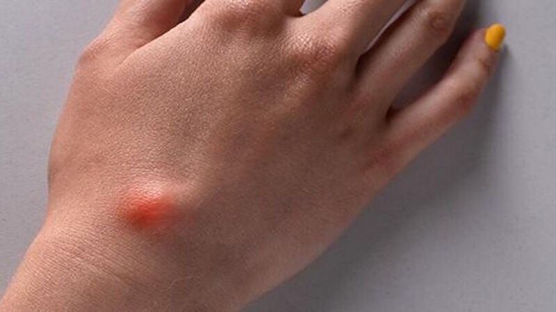 Sarcoma mô mềm có thể trông giống một cục u dưới da