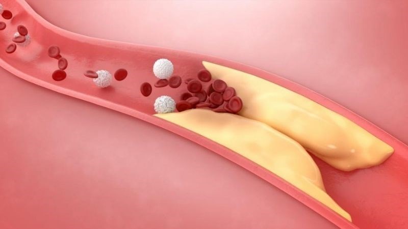 Cholesterol cao có thể dẫn đến tăng lắng đọng cholesterol ở thành mạch máu Cholesterol cao có thể dẫn đến tăng lắng đọng cholesterol ở thành mạch máu