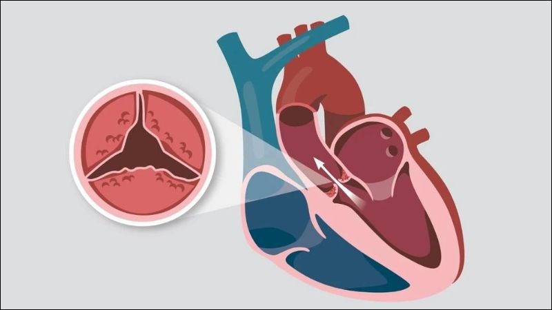 Hẹp van động mạch chủ là tình trạng đường kính lá van động mạch chủ bị thu hẹp lại Hẹp van động mạch chủ là tình trạng đường kính lá van động mạch chủ bị thu hẹp lại