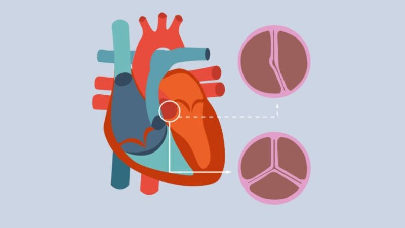Hẹp van động mạch chủ có thể do bất thường cấu trúc van bẩm sinh Hẹp van động mạch chủ có thể do bất thường cấu trúc van bẩm sinh