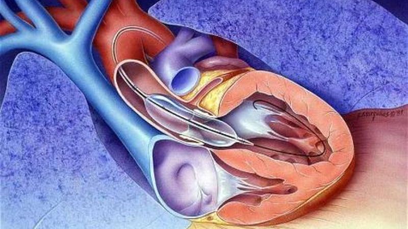 Nong van động mạch chủ là phương pháp điều trị có hiệu quả với trẻ nhỏ Nong van động mạch chủ là phương pháp điều trị có hiệu quả với trẻ nhỏ