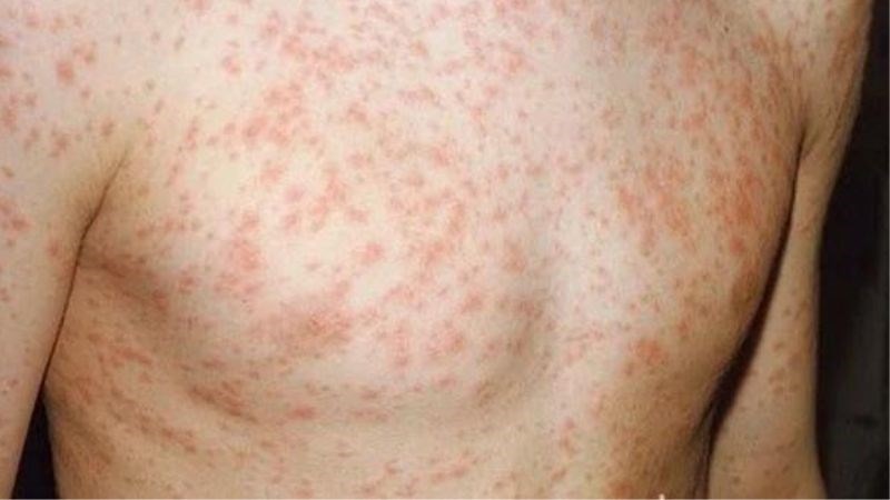 Bệnh sởi gia tăng tại nhiều địa phương