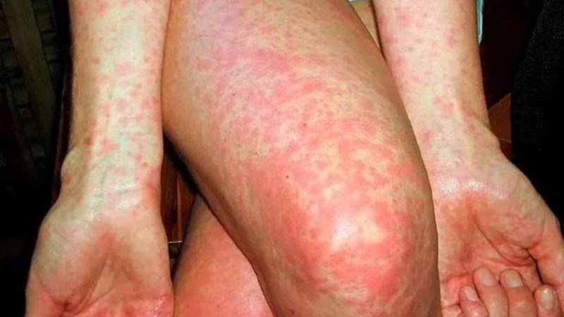 Sốt tinh hồng nhiệt có đặc trưng gồm sốt cao và nổi mảng sần trên da tay và đùi Sốt tinh hồng nhiệt có đặc trưng gồm sốt cao và nổi mảng sần trên da tay và đùi