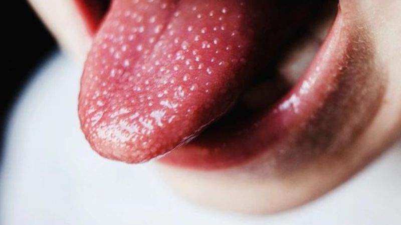 Bệnh sốt tinh hồng nhiệt có đặc trưng là lưỡi sưng giống quả dâu tây Bệnh sốt tinh hồng nhiệt có đặc trưng là lưỡi sưng giống quả dâu tây