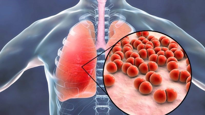 Sốt tinh hồng nhiệt không được điều trị kịp thời có thể dẫn đến viêm phổi Sốt tinh hồng nhiệt không được điều trị kịp thời có thể dẫn đến viêm phổi