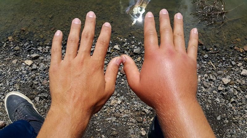 Sưng bàn tay là tình trạng tay tăng kích thước và da căng bóng