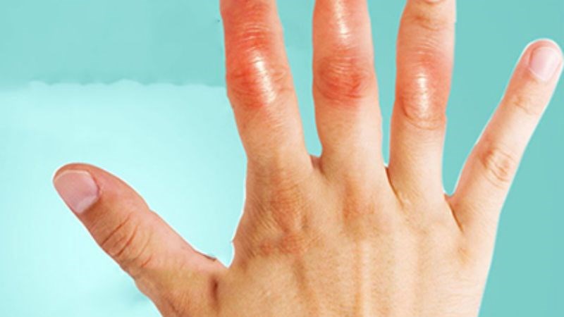 Sưng đỏ bàn tay là dấu hiệu cần đến gặp bác sĩ sớm