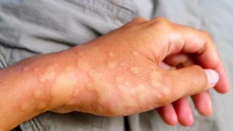 Sưng bàn tay kèm theo nổi mẩn đỏ là triệu chứng của dị ứng