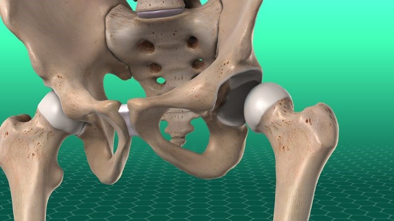 Trật khớp háng là tình trạng chỏm xương đùi bị di lệch ra khỏi ổ cối Trật khớp háng là tình trạng chỏm xương đùi bị di lệch ra khỏi ổ cối