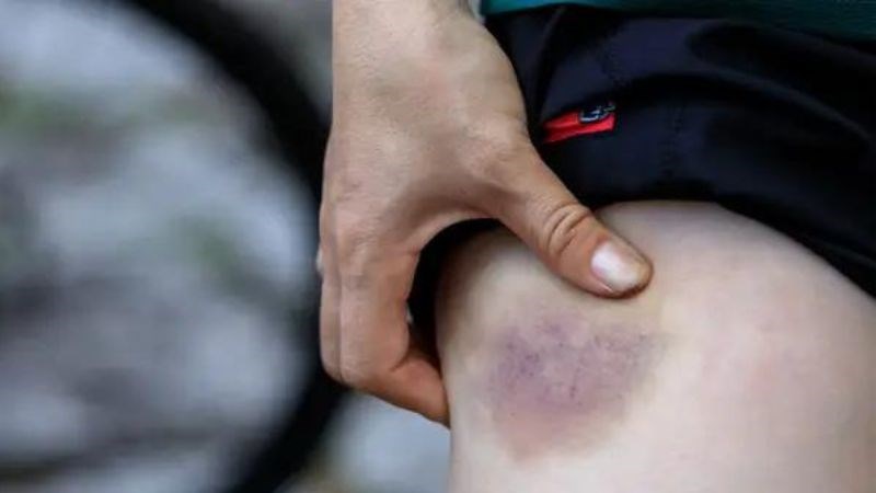 Tụ máu là tình trạng máu thoát ra khỏi thành mạch và tập trung ở xung quanh