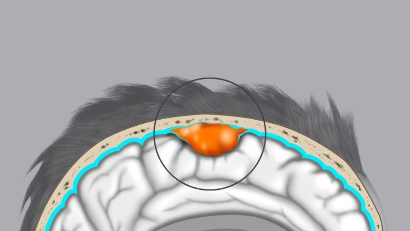 U màng não là tình trạng xuất hiện khối tăng sinh bất thường có nguồn gốc từ màng nhện U màng não là tình trạng xuất hiện khối tăng sinh bất thường có nguồn gốc từ màng nhện