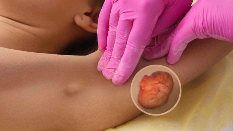 U mỡ lành tính là các khối tròn hoặc bầu dục có ranh giới rõ ràng dưới da