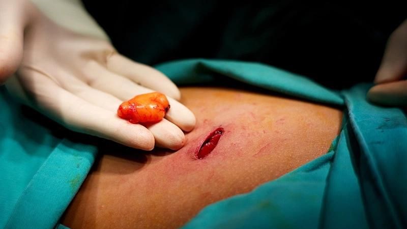 Phẫu thuật là phương pháp giúp loại bỏ khối u mỡ hiệu quả