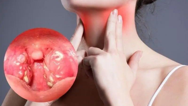 Viêm họng có thể kèm theo viêm amidan