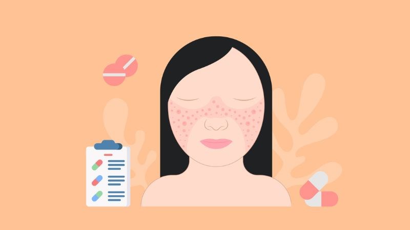 Người bệnh lupus ban đỏ sẽ có nguy cơ mắc viêm thị thần kinh cao hơn