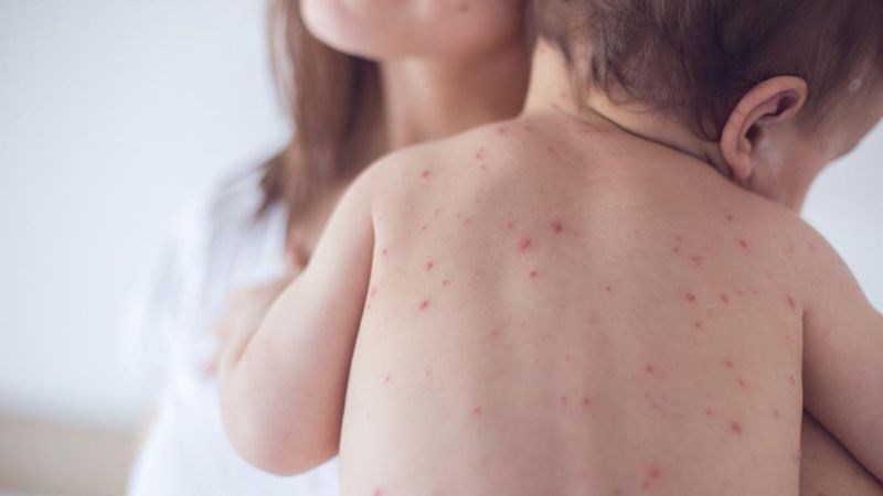 Nhiễm sởi có thể là nguyên nhân của bệnh viêm thị thần kinh