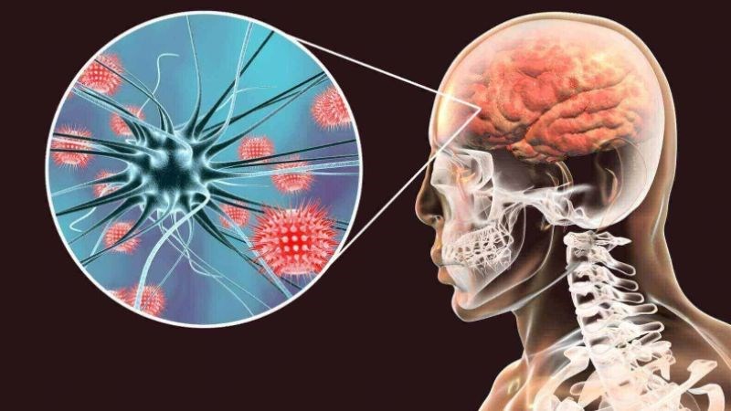 Viêm màng não có thể là nguyên nhân của bệnh