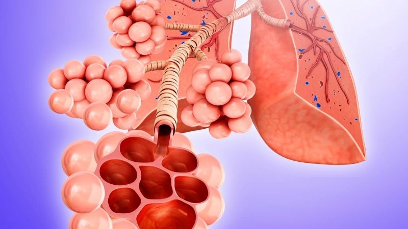 Xẹp phổi là bệnh lý do phế nang không thể nở ra đúng cách Xẹp phổi là bệnh lý do phế nang không thể nở ra đúng cách