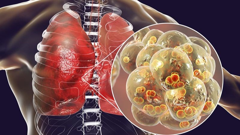 Xẹp phổi nếu không được điều trị có thể dẫn đến viêm phổi Xẹp phổi nếu không được điều trị có thể dẫn đến viêm phổi