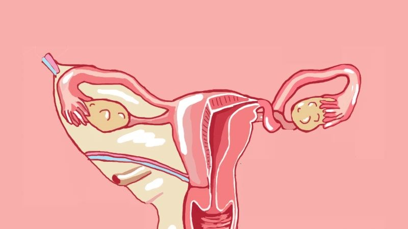 Xoắn buồng trứng là tình trạng buồng trứng bị xoắn quanh dây chằng giữ nó trong ổ bụng