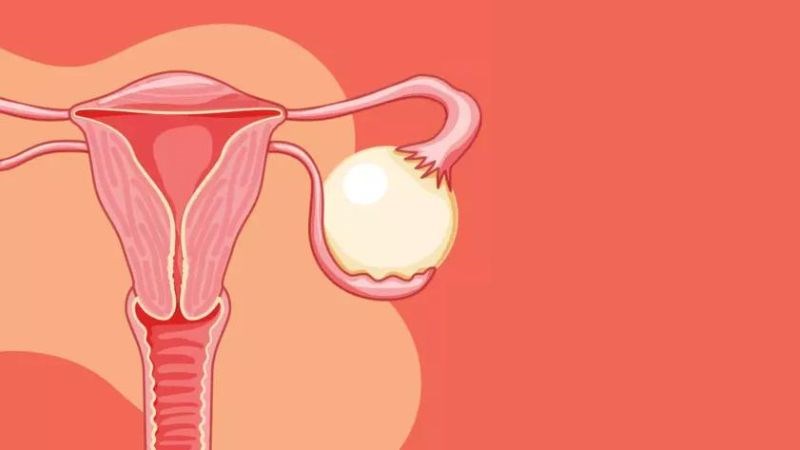 U nang buồng trứng là một trong những nguyên nhân gây xoắn buồng trứng
