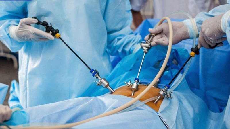 Phẫu thuật nội soi là phương pháp điều trị phổ biến của bệnh xoắn buồng trứng