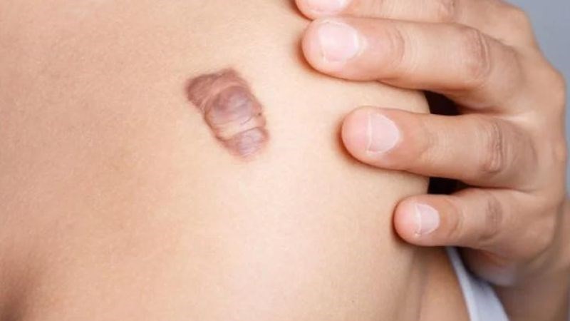 Nếu cơ địa dễ bị sẹo lồi, nên tránh những thực phẩm có nguy cơ làm tăng sinh collagen