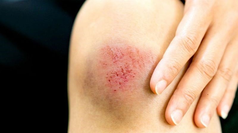 Hạn chế xoa bóp lên vùng vết thương để tránh gây rách các tế bào mới hình thành