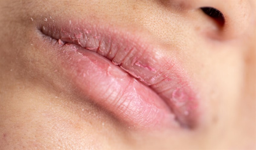 Mùa đông không khí hanh khô gây nứt môi