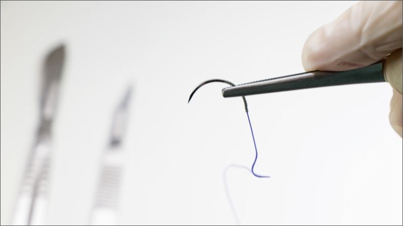 Phương pháp cấy chỉ xương khớp sử dụng chỉ tự tiêu cấy vào các huyệt vị trong cơ thể