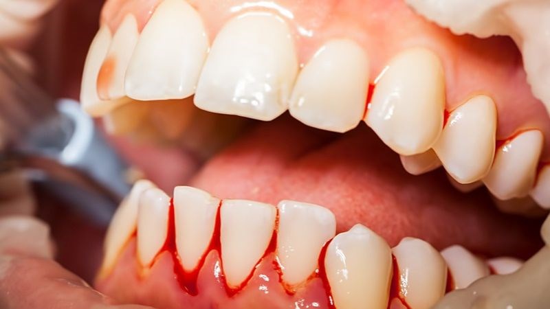 Chảy máu chân răng là tình trạng máu chảy ra ở vùng nướu, sát chân răng