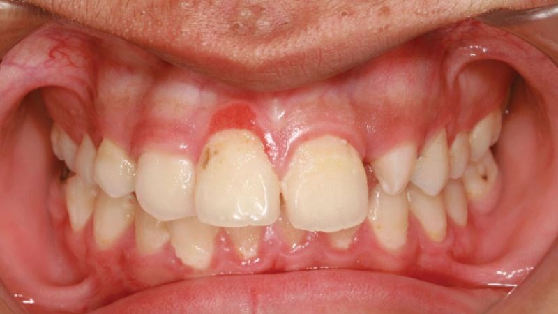 Viêm nướu có thể gây ra chảy máu chân răng