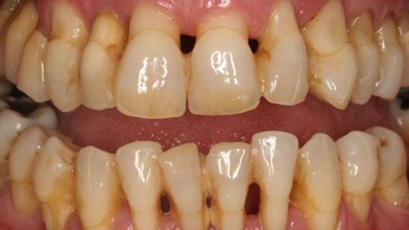 Chảy máu chân răng có thể xuất hiện do viêm nha chu