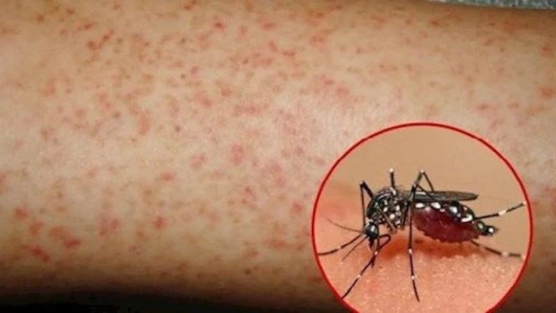 Sốt xuất huyết có thể là nguyên nhân gây chảy máu chân răng