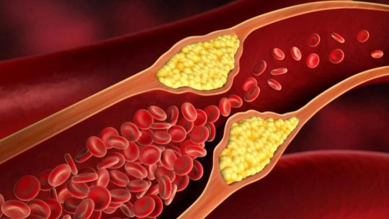 Xơ vữa động mạch vành là một trong những nguyên nhân gây đau thắt ngực