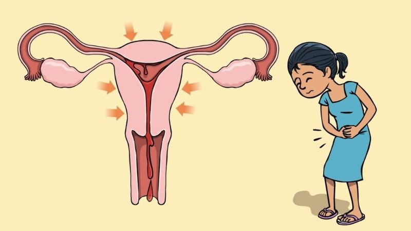 Đau bụng kinh nguyên phát có liên quan đến hoạt động co bóp của tử cung Đau bụng kinh nguyên phát có liên quan đến hoạt động co bóp của tử cung
