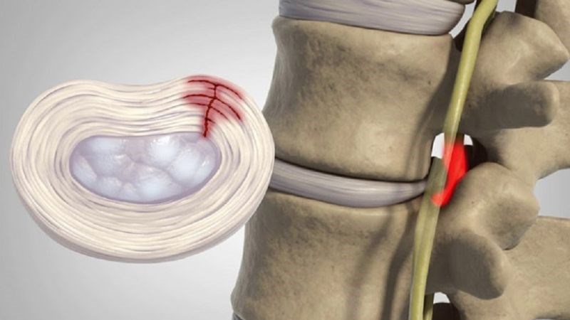 Người bệnh thoát vị đĩa đệm ở cột sống ngực thường có triệu chứng đau lưng trên