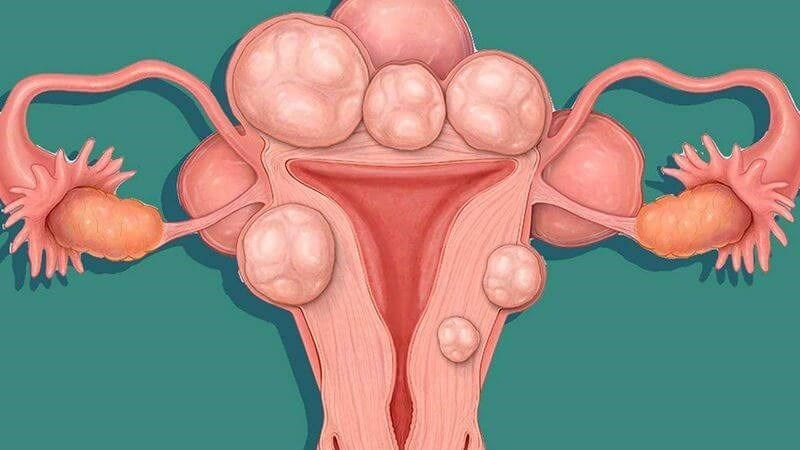 U xơ tử cung là bệnh lý gây ra đau vùng hạ vị