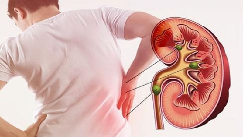 Sỏi thận cũng có thể gây ra đau vùng hạ vị